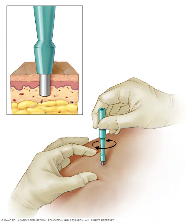 Punch biopsy screening procedure