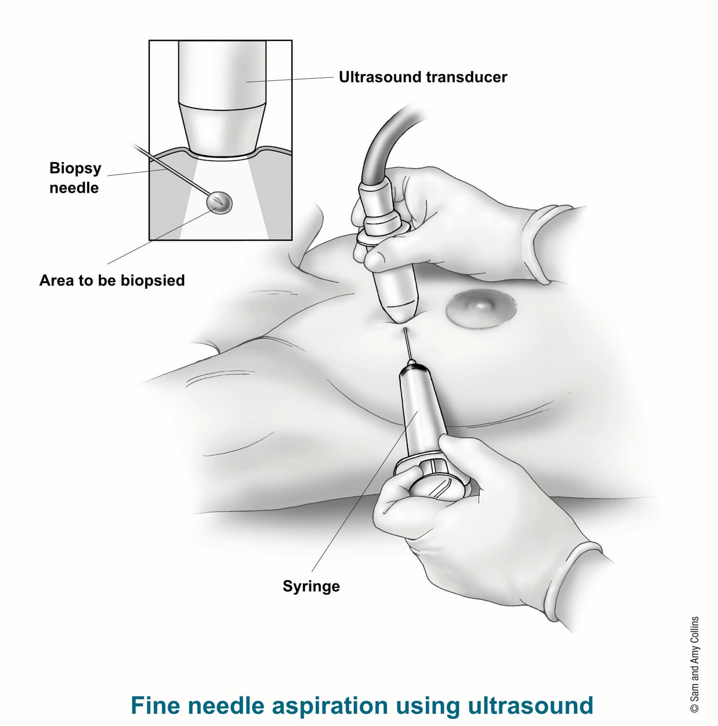 Fine-Needle Aspiration Biopsy screening procedure
